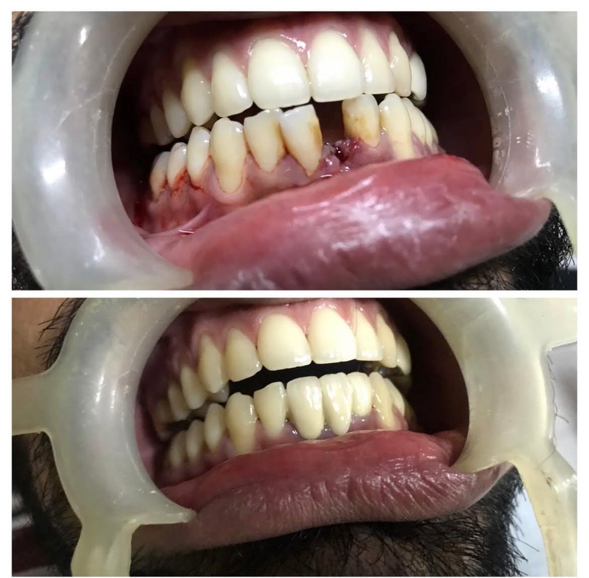 Crowded Tooth Correction